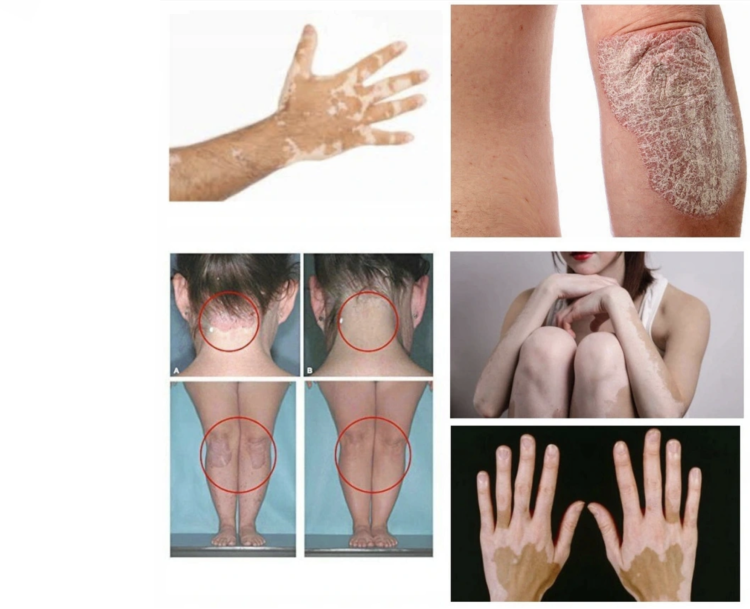 fototerapia-dvf32.png
