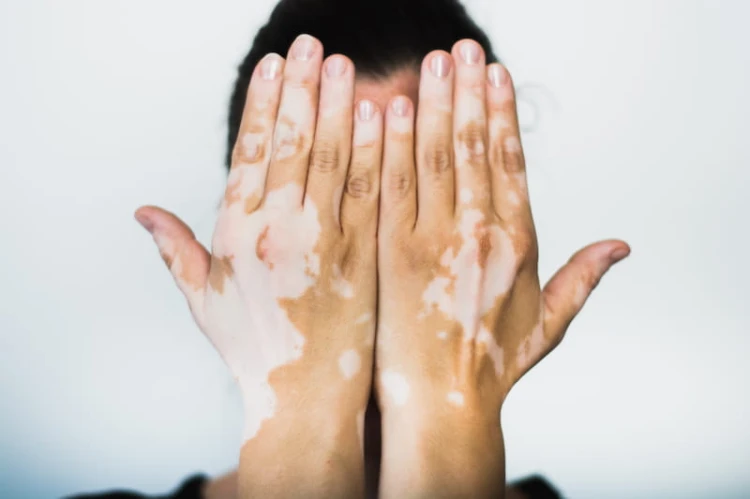 8-Vitiligo.jpg